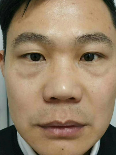 去眼袋手术