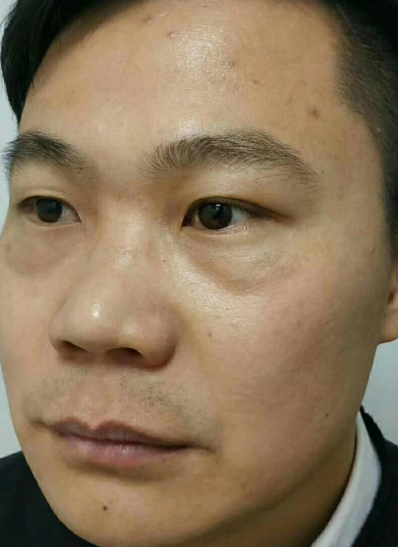 去眼袋手术