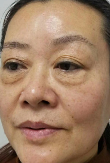 去眼袋手术