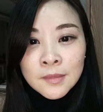 去眼袋手术