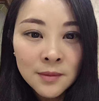 去眼袋手术