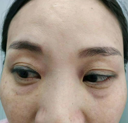 去眼袋手术
