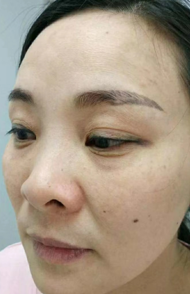 去眼袋手术