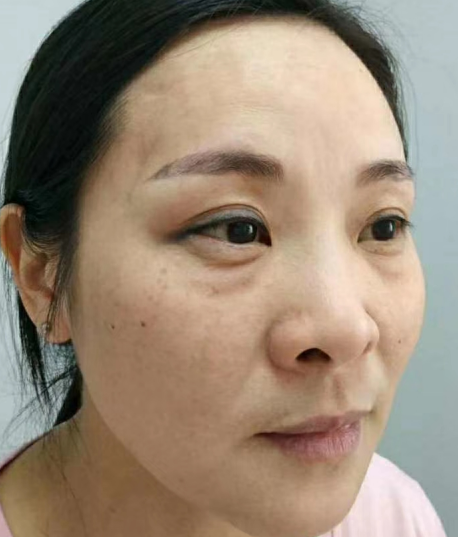 去眼袋手术