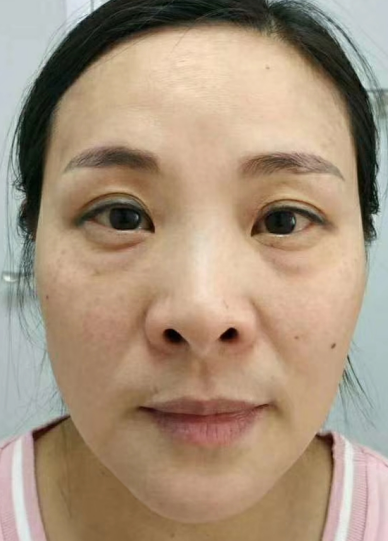 去眼袋手术