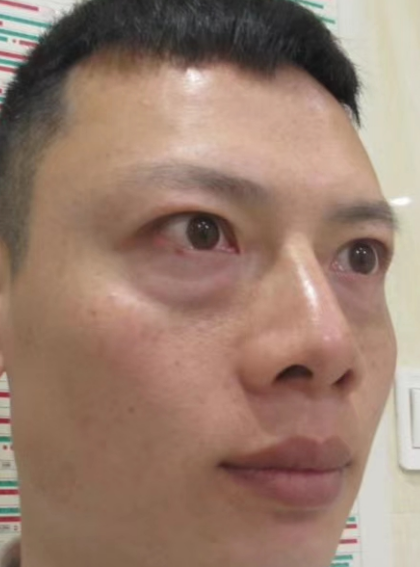 去眼袋手术