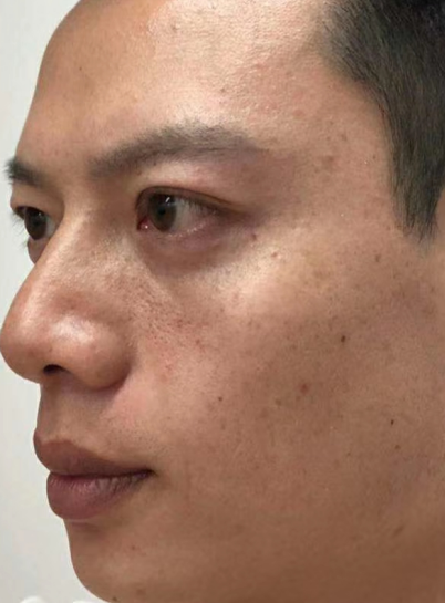 去眼袋手术