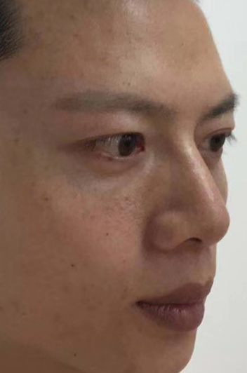 去眼袋手术