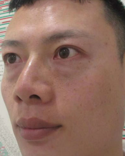去眼袋手术