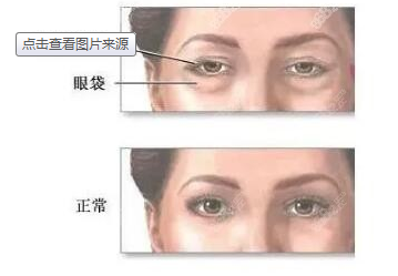 去眼袋手术