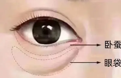 去眼袋手术
