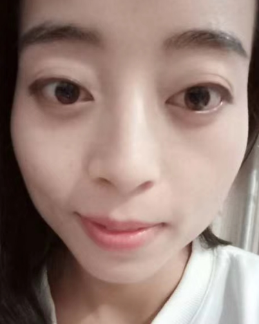 去眼袋手术