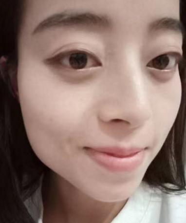 去眼袋手术