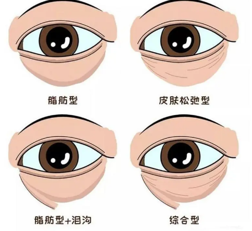 去眼袋手术