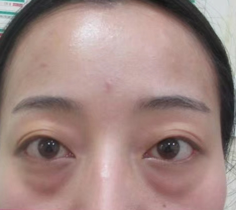 去眼袋手术