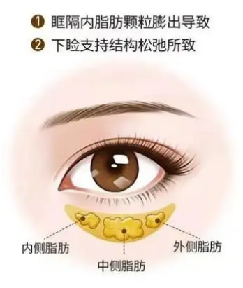 去眼袋手术