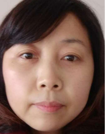 去眼袋手术