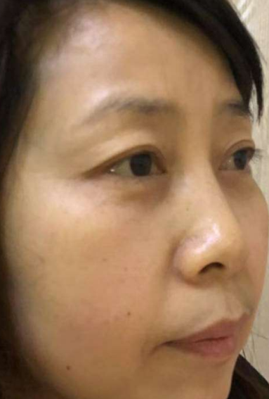 去眼袋手术
