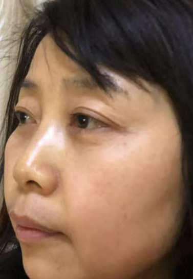 去眼袋手术