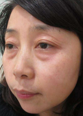 去眼袋手术