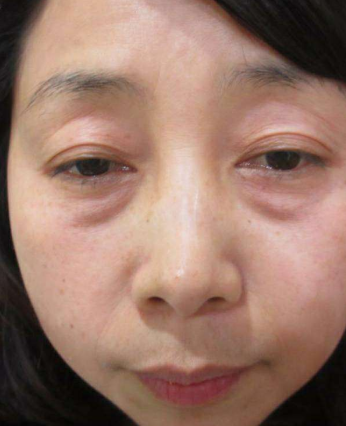 去眼袋手术