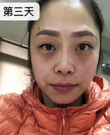 去眼袋手术