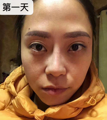 去眼袋手术