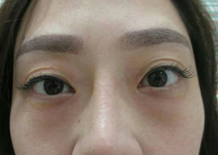 去眼袋手术
