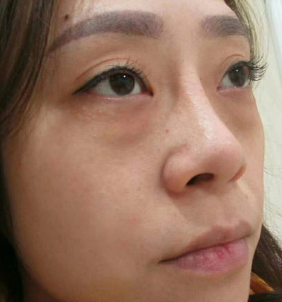 去眼袋手术