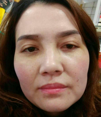 去眼袋手术