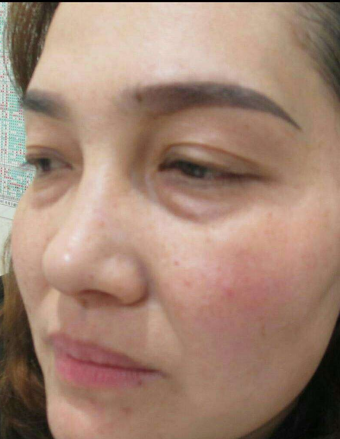 去眼袋手术