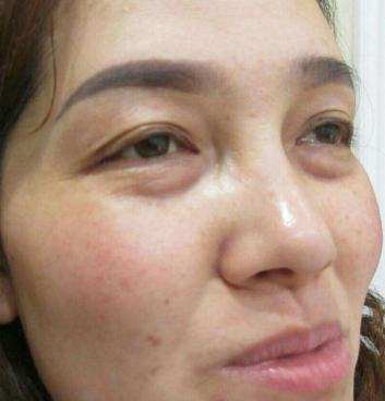 去眼袋手术