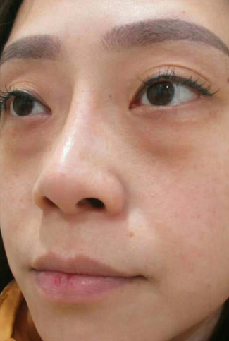 去眼袋手术