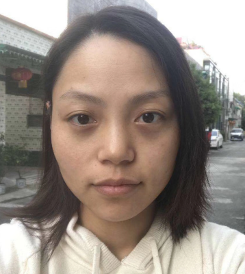去眼袋手术