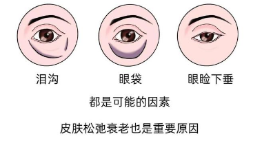 去眼袋手术