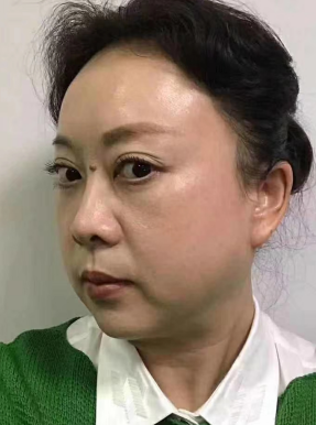 去眼袋手术