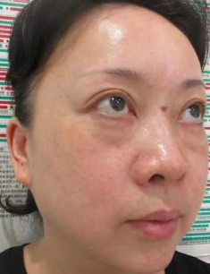 去眼袋手术