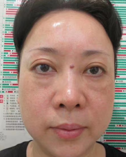 去眼袋手术