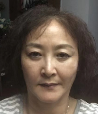 去眼袋手术