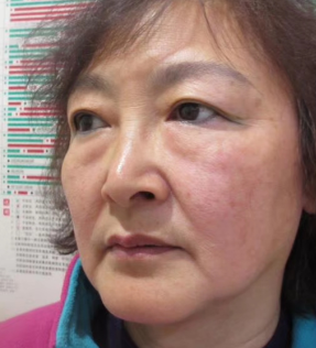 去眼袋手术