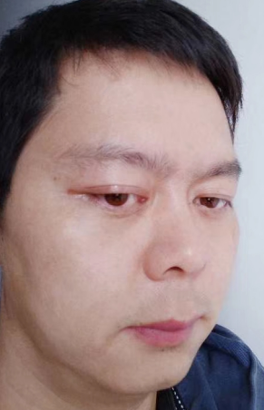 去眼袋手术