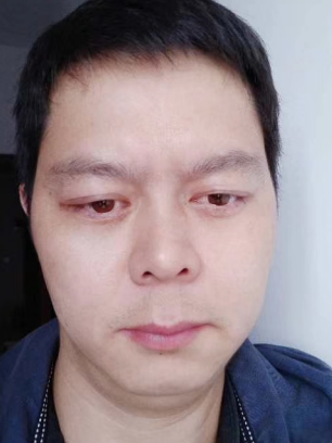 去眼袋手术