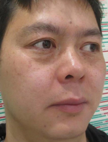 去眼袋手术