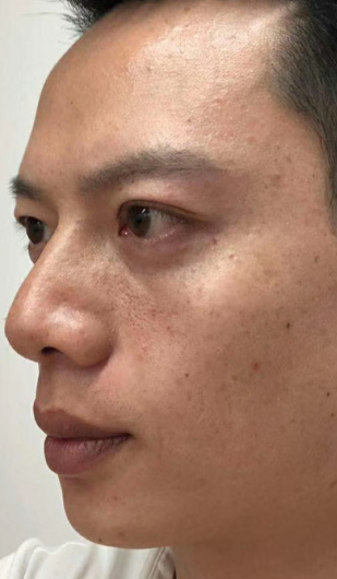 去眼袋手术