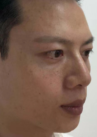 去眼袋手术