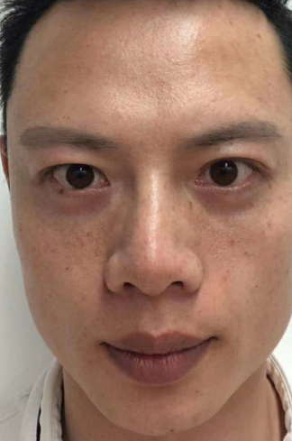 去眼袋手术