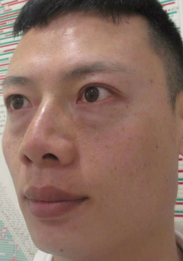 去眼袋手术