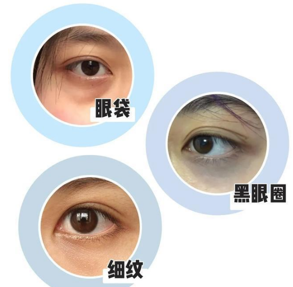 去眼袋手术