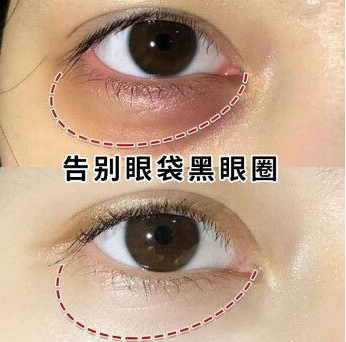 去眼袋手术