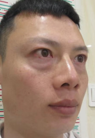 去眼袋手术